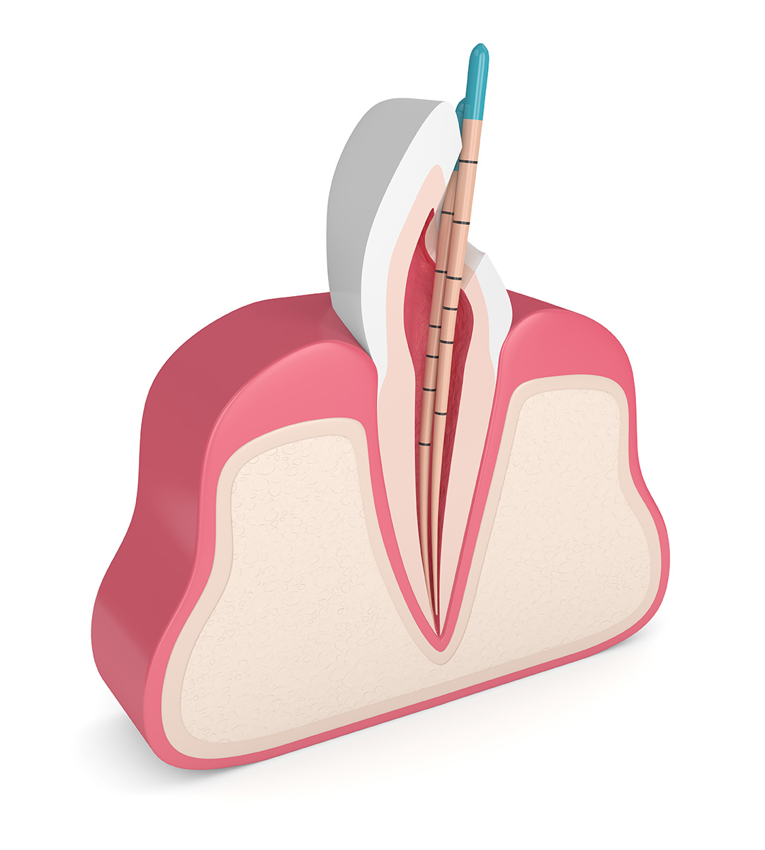 Root Canal Treatment Scarsdale, NY Scarsdale Personal Dental